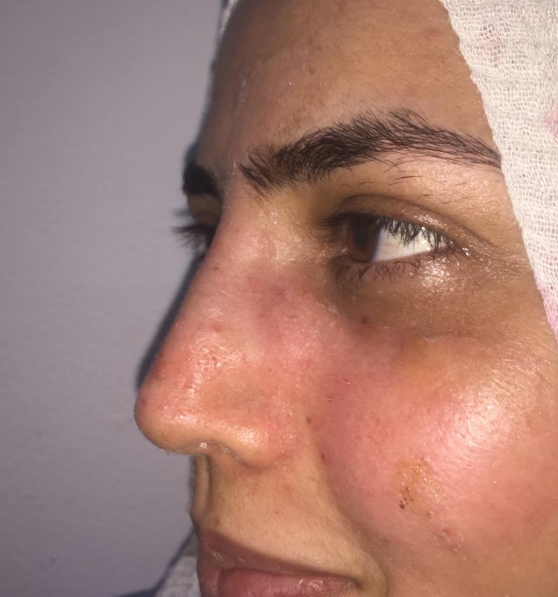 Rhinoplasty, Nose Job, Primary Rhinoplasty, Nose Hump, Best Cosmetic Surgery