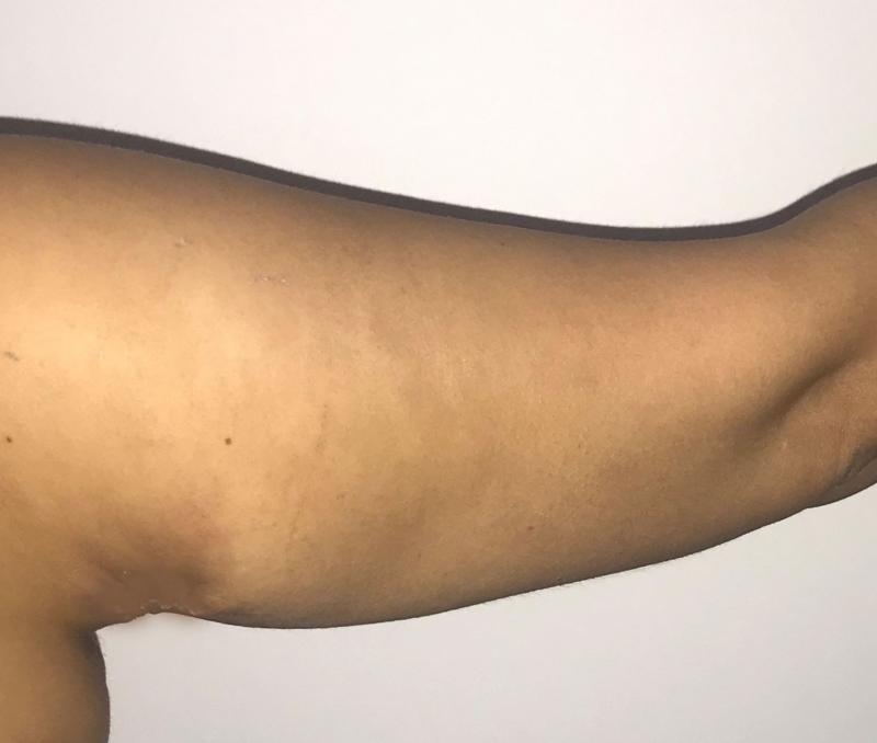 Arm lift, Armpit scar, Vaser Liposuction, Arm Surgery, Gastric sleeve, Plastic