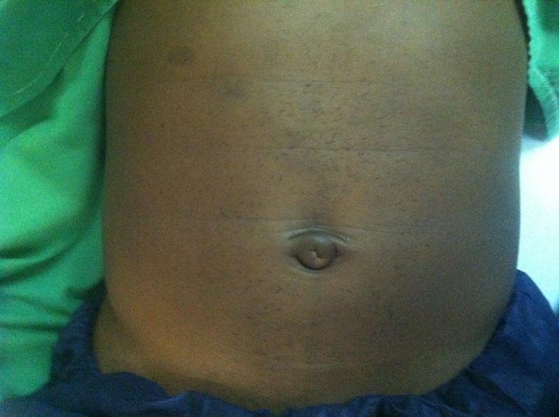 Tummy Tuck Egypt, Belly button Repair Egypt, Umbilicus repair, Best Plastic Surg