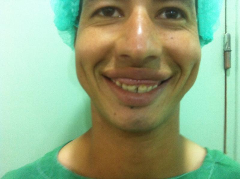 Lip surgery Egypt, Double Lip, osmetic surgery Egypt, face Lift, Liposuction