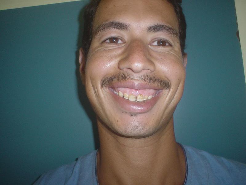 Lip surgery Egypt, Double Lip, Plastic surgery Egypt, face Lift, Liposuction