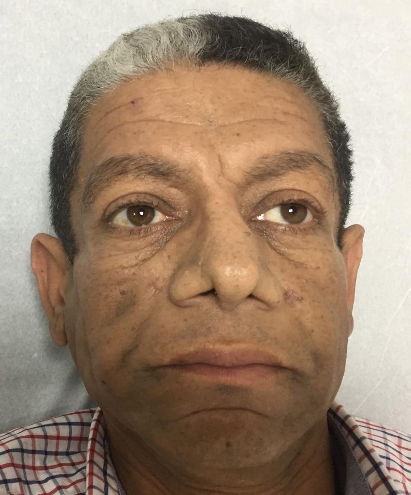 Best Plastic Surgery, Face Lift, Fat Injection, Arm Lift, Nasolabial filler