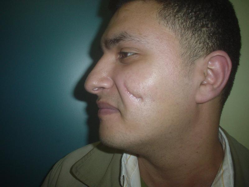 Best  Plastic Surgery Egypt, Scars, Stem Cells, Face surgery, Face lift, Keloid