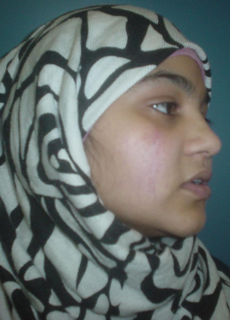 Best Plastic surgery in Egypt, Cheek Surgery, Scar Surgery, Stem Cells, Laser