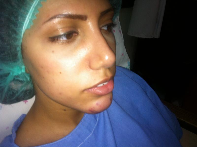 Best Plastic Surgeon Egypt, Cheek Dimples, Cheek Implants, Face surgery Egypt 