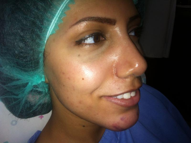 Best Cosmetic Surgeon Egypt, Cheek Dimples, Cheek Implants, Face surgery Egypt