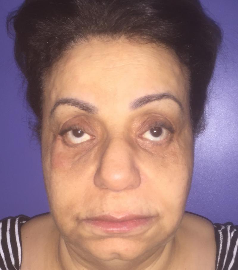Fat Injection, Fat Grafting, Stem Cells, Face Lift, Face wrinkles, Best cosmetic