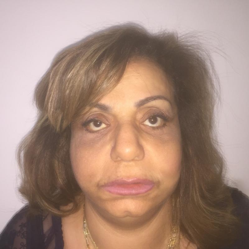 Fat Injection, Fat Grafting, Stem Cells, Face Lift, Face wrinkles, Best plastic