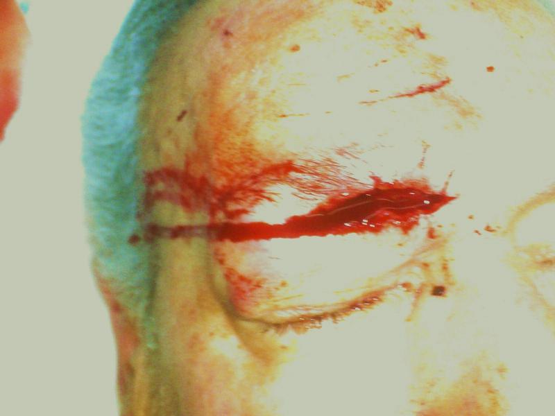 Cosmetic Surgery Egypt Cairo Wounds scar deformity juvederm botox Wilson nose