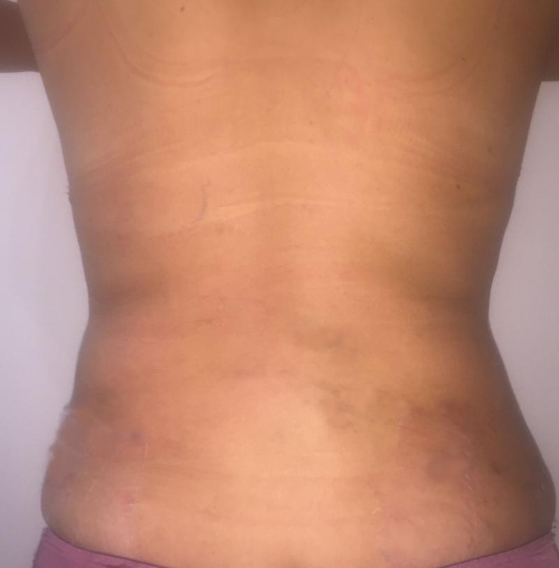 Back Liposuction, Bra-Line Liposuction, Love Handle Liposuction, Vase Liposuctio