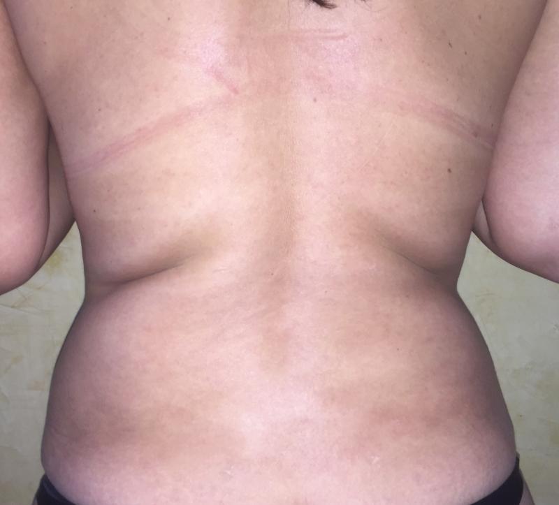 Back Liposuction, Bra-Line Liposuction, Love Handle Liposuction, 4-D Liposuction