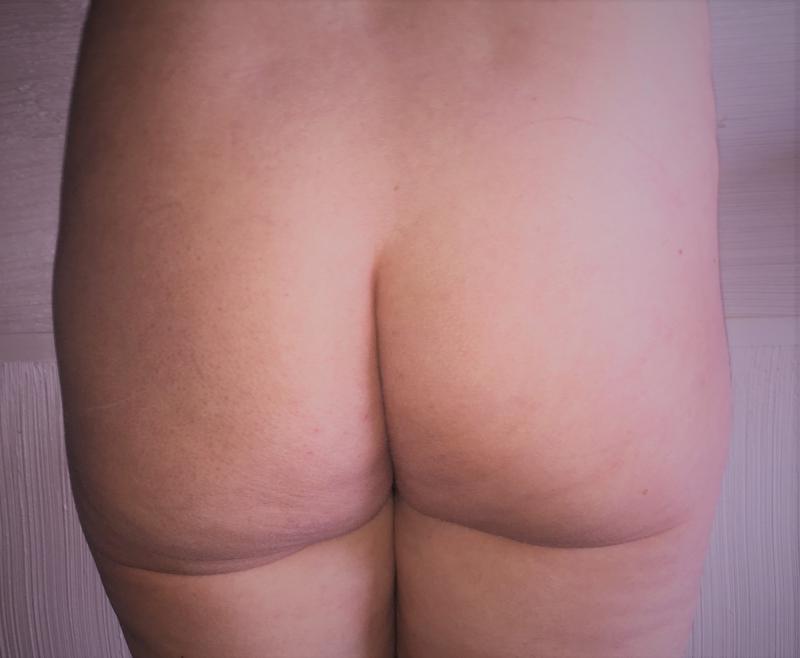 Brazilian Butt Lift, Butt Augmentation, Butt Enlargement, Best Cosmetic Surgery