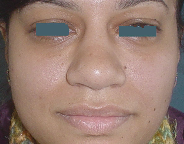 Best Plastic Surgeon Egypt, Nose Hump Egypt, Nose boxy tip Egypt, Rhinoplasty