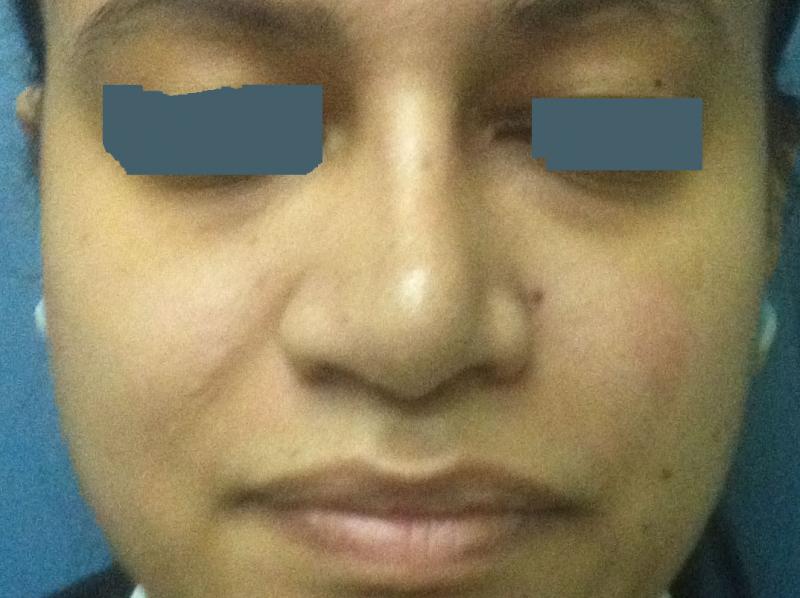 Best Plastic Surgeon Egypt, Rhinoplasty, Nose job, Big nose, Nasal tip boxy tip