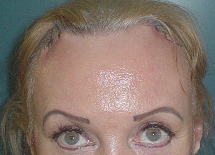 Forehead Reduction, Forehead Lift, Face Laser, Face Lift, Best Cosmetic Surgery
