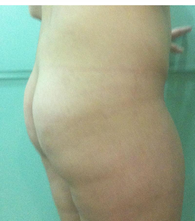 Best Plastic Surgery Egypt, Buttock Augmentation, Buttock Enlargement, Silicon