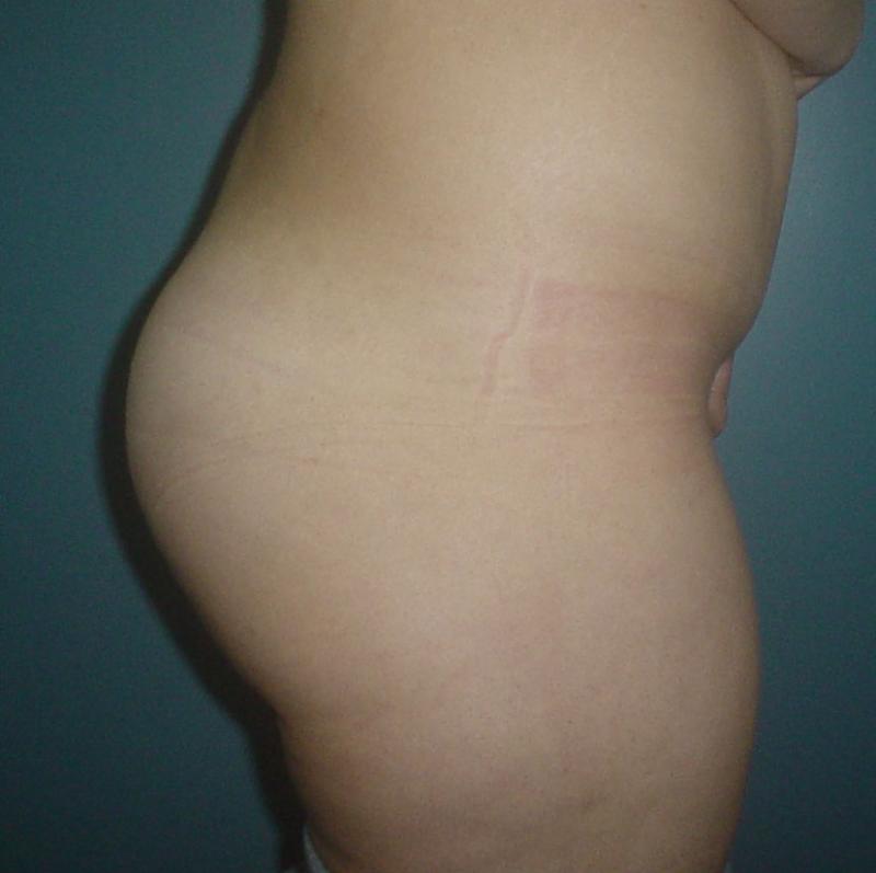 Best Cosmetic Surgery Egypt, Buttock Augmentation, Buttock Enlargement, Silicon