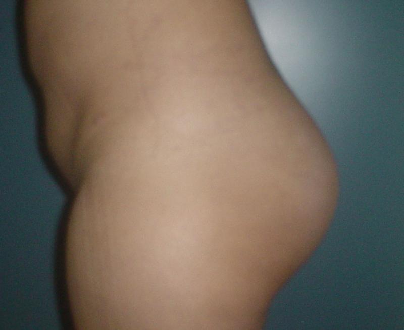 Best Plastic Surgeon Egypt, Butt Implants, Gluteal Implants, Butt Augmentation