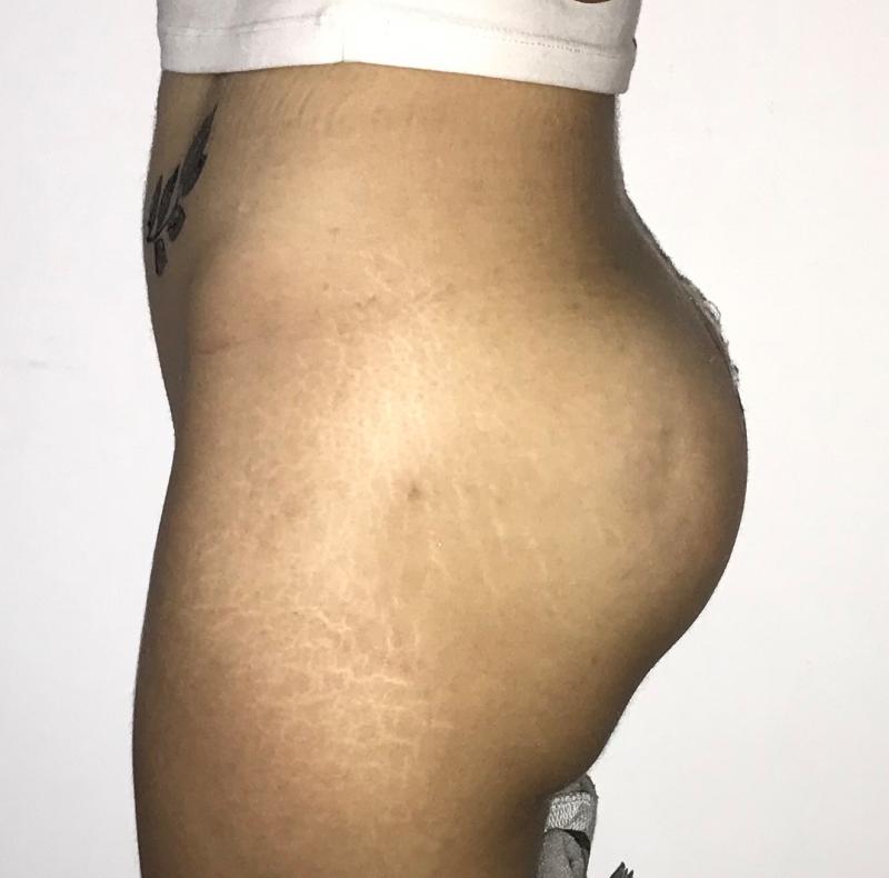 Best Cosmetic Surgery in Egypt for Butt Enlargement by Silicone Implants and BBL