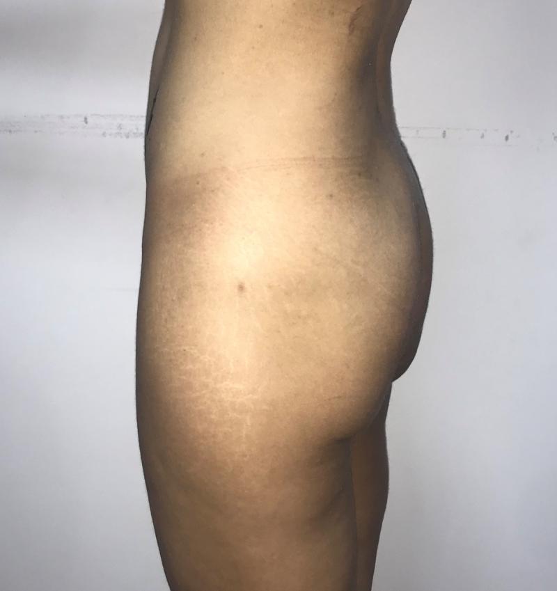 Best Plastic Surgery in Egypt for Butt Enlargement by Silicone Implants and BBL