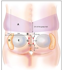 Butt Implants and Brazilian Butt Lift, Cosmetic Butt Enlargement, Hip Enlargemen