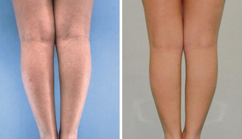 Plastic Surgery in Egypt Fat Liposuction calf lift implant  tuck 