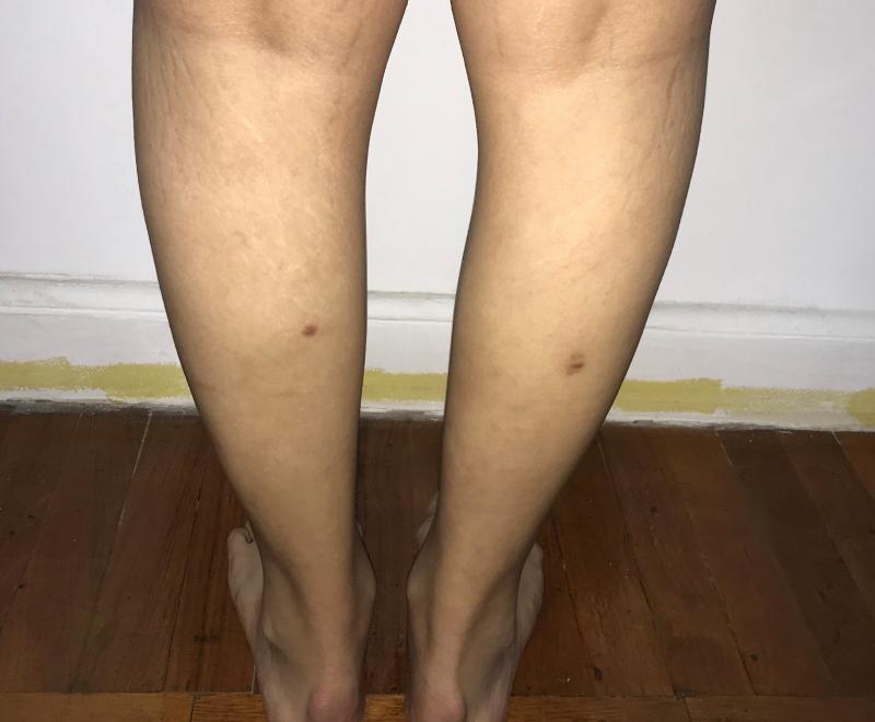 Calf Silicon Implants for leg Augmentation at Best Plastic Surgery in Egypt