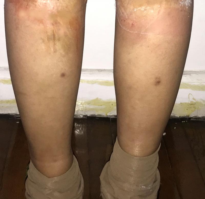 Calf Silicon Implants for leg Augmentation at Best Cosmetic Surgery in Egypt