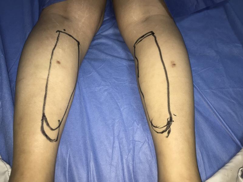 Calf Silicon Implants for leg Augmentation at Best Aesthetic Surgery in Egypt