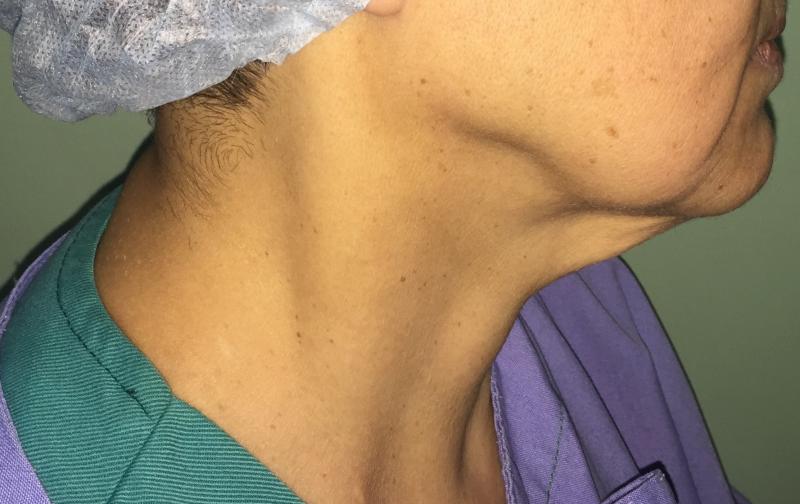 Best Plastic Surgery Egypt, Neck Lift, Neck Liposuction, Neck Laser Liposuction,