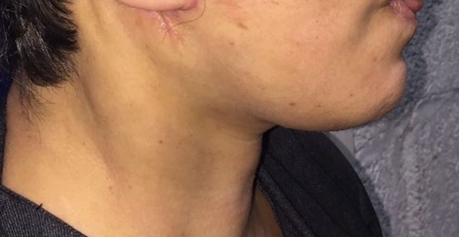 Best Cosmetic Surgery Egypt, Neck Lift, Neck Bands, Neck Vaser Laser Liposuction
