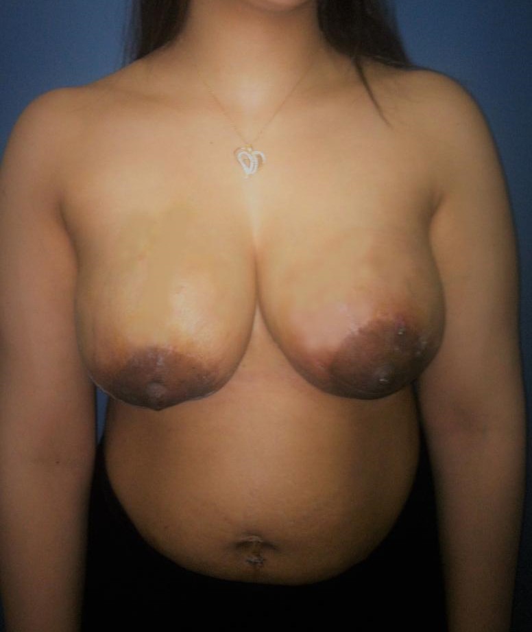 Breast Enlargement and Lift, Augmentation Mastopexy, Best Cosmetic Surgery Egypt