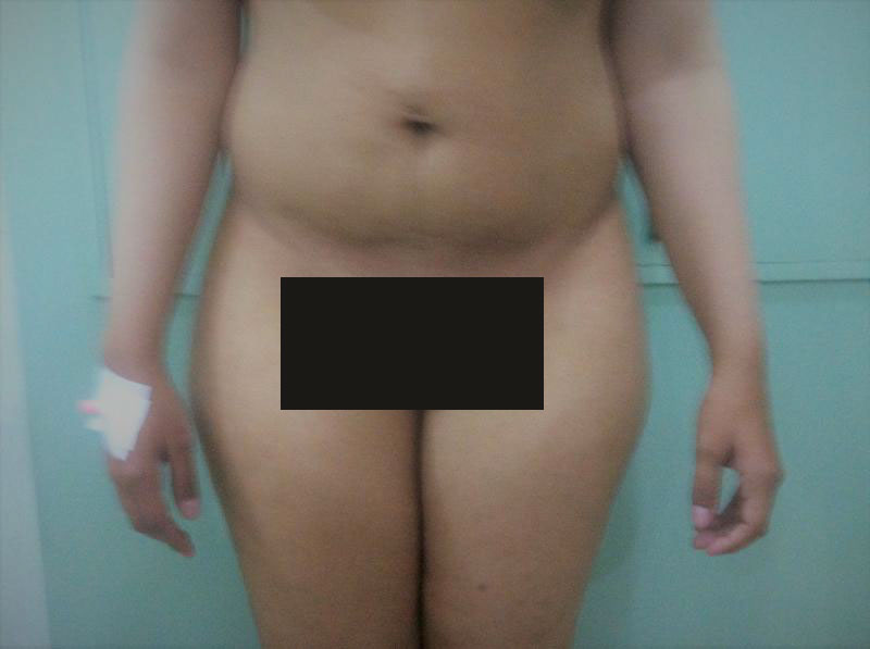 Breast Enlargement and Lift, Augmentation Mastopexy, Best Plastic Surgery Egypt