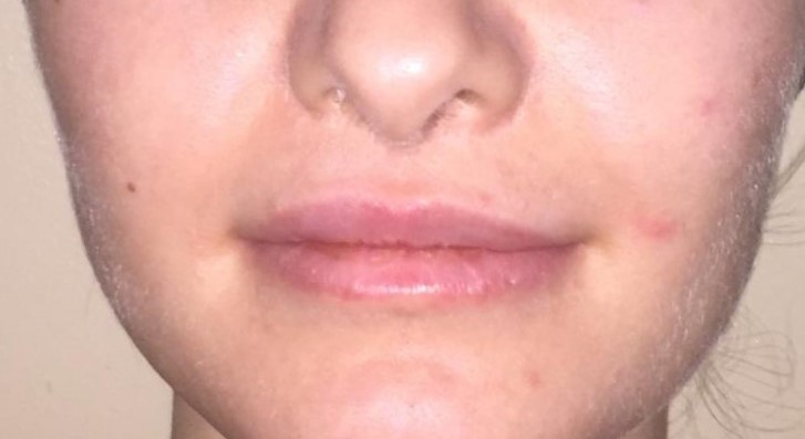 Cheek Dimples, Best cosmetic Surgery, Buccal Fat Removal, Face Dimple Lift