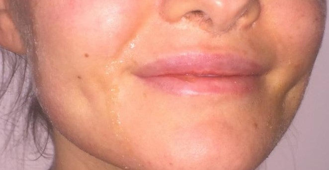 Cheek Dimples, Best Plastic Surgery, Buccal Fat Removal, Face Dimple Lift