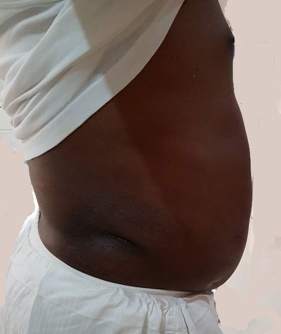 Abdominal Liposuction, 4 D Liposuction, Vaser Liposuction, Best Cosmetic Surgery