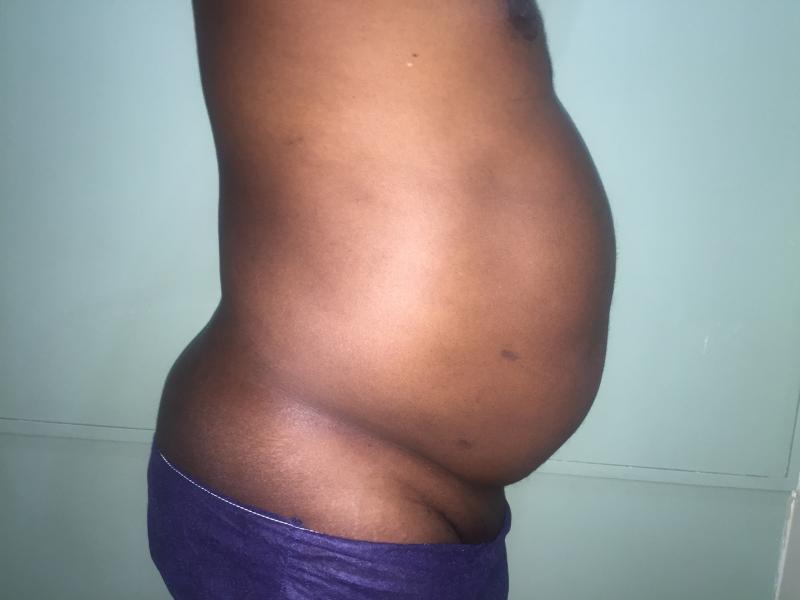 Abdominal Liposuction, 4 D Liposuction, Vaser Liposuction, Best Plastic Surgery