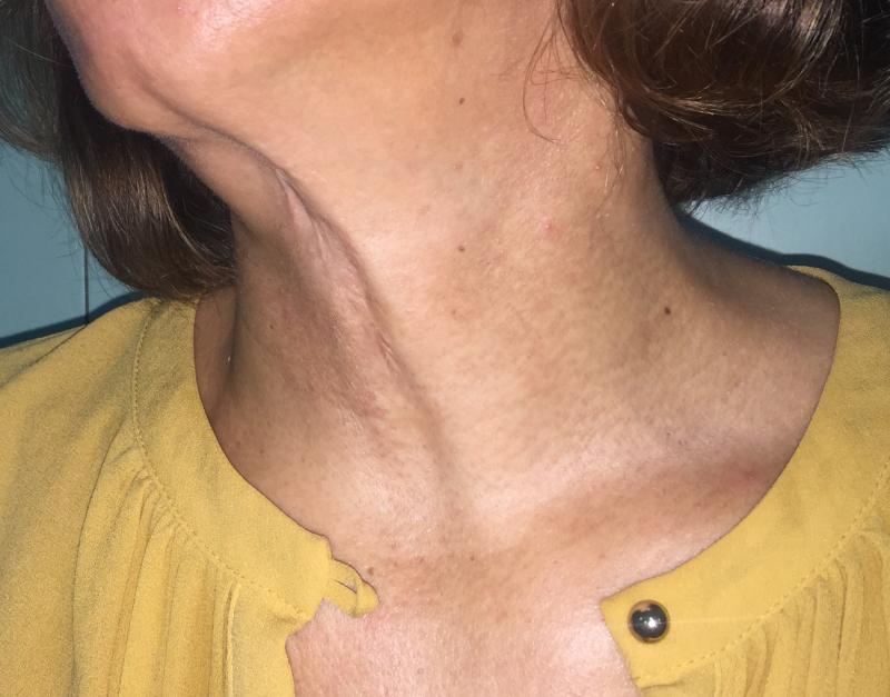 Neck Lift, Neck liposuction, Laser Liposuctio, Neck Contour, Best Cosmetic Surge