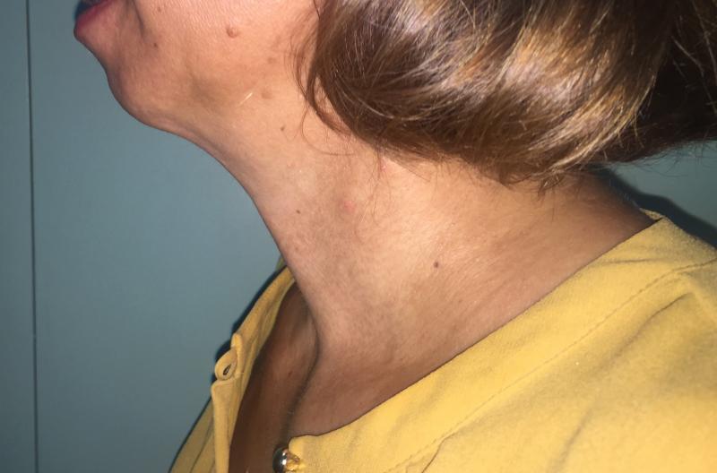 Neck Lift, Neck liposuction, Laser Liposuctio, Neck Contour, Best Plastic Surger