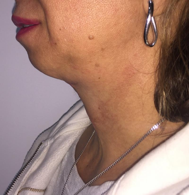 Neck Lift, Neck liposuction, Vaser Liposuctio, Neck Contour, Best Plastic Surger