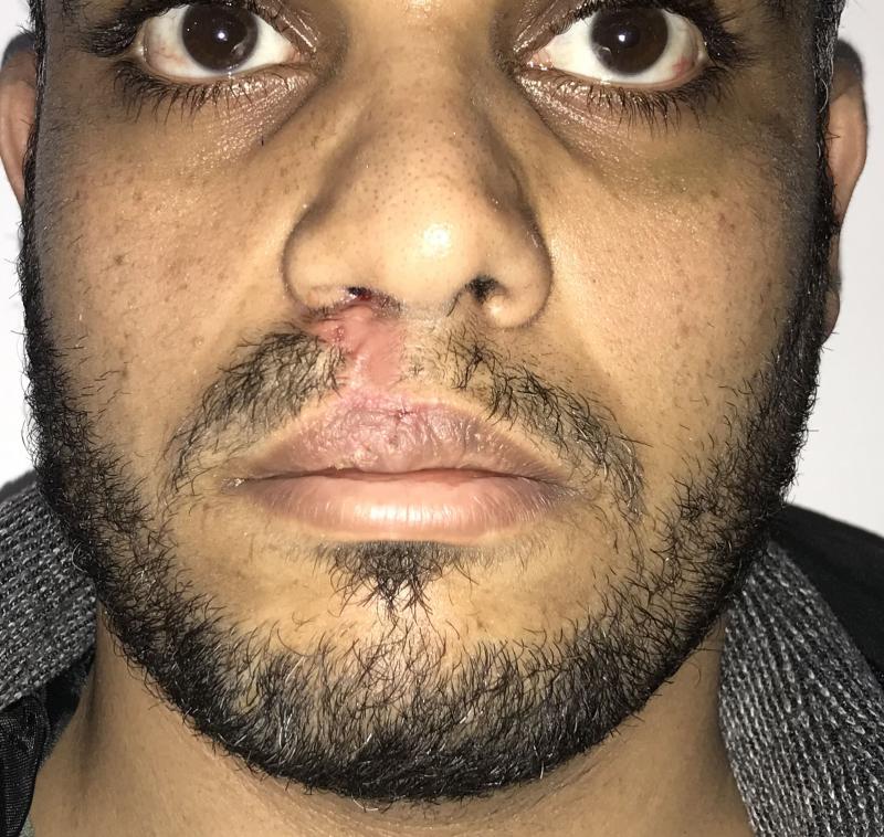 Cleft Lip, Nose Job, Lip correction enlargement at Best Plastic surgery in egypt