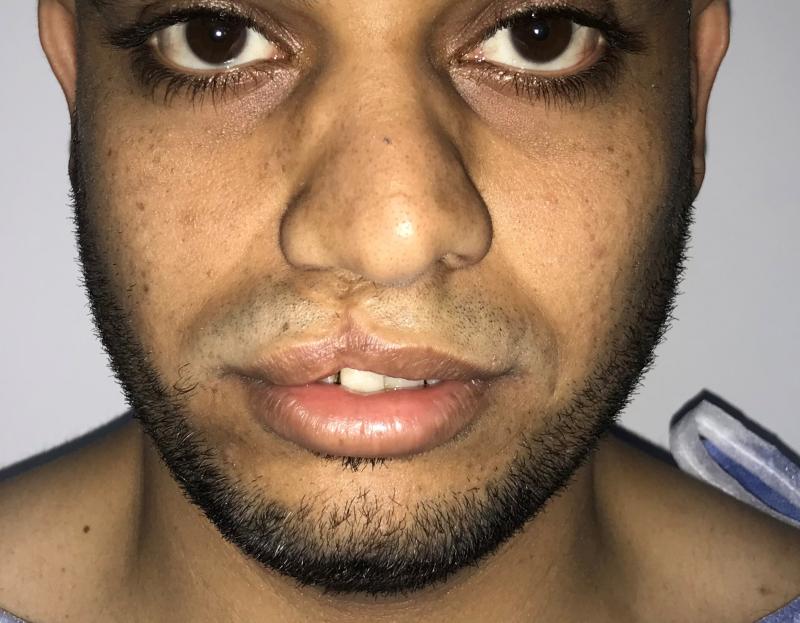 Cleft Lip, Nose Job, Lip correction enlargement at Best Cosmetic surgery in egyp