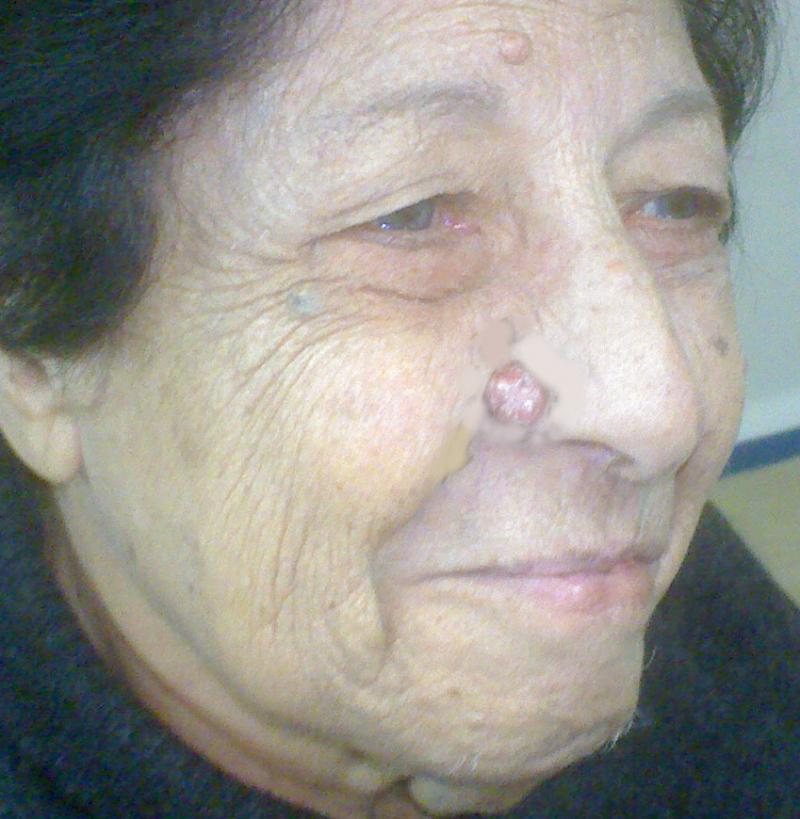 Plastic Surgery Egypt Cosmetic Cairo Rodent Ulcer Face Reconstruction Tumor