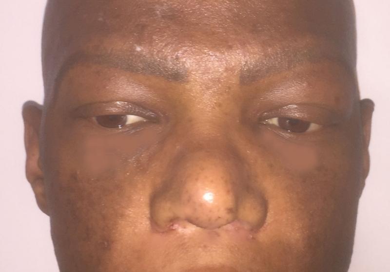 Nose Job, Rhinoplasty, Broad Tip, Boxy Tip, Wide Ala, Negroid Nose, Plastic surg