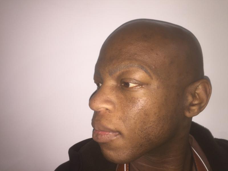 Nose Job, Rhinoplasty, Broad Tip, Boxy Tip, Wide Ala, Negroid Nose, Aesthetic