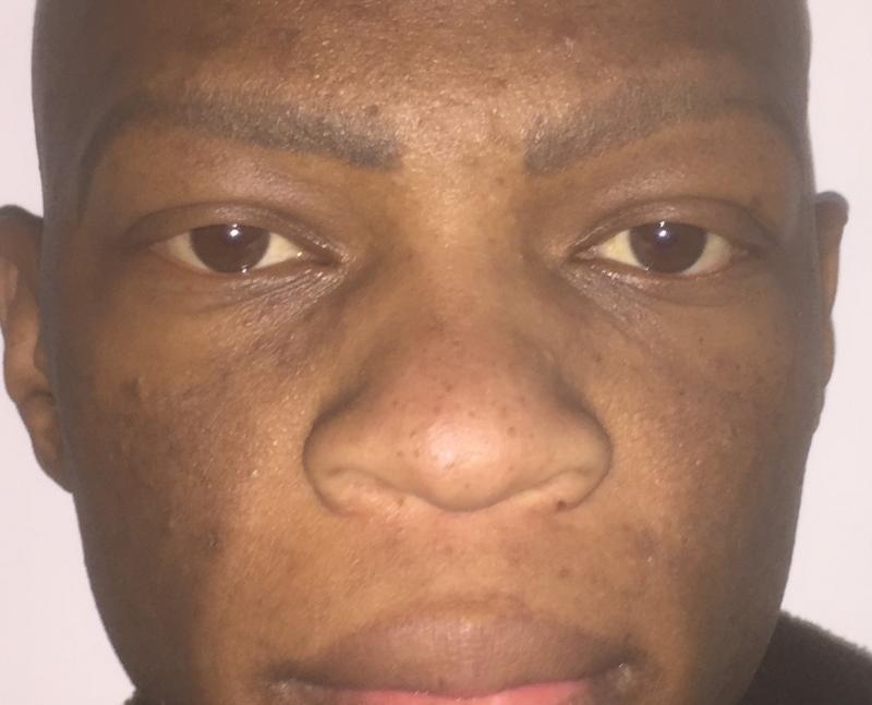 Nose Job, Rhinoplasty, Broad Tip, Boxy Tip, Wide Ala, Negroid Nose, cosmetic