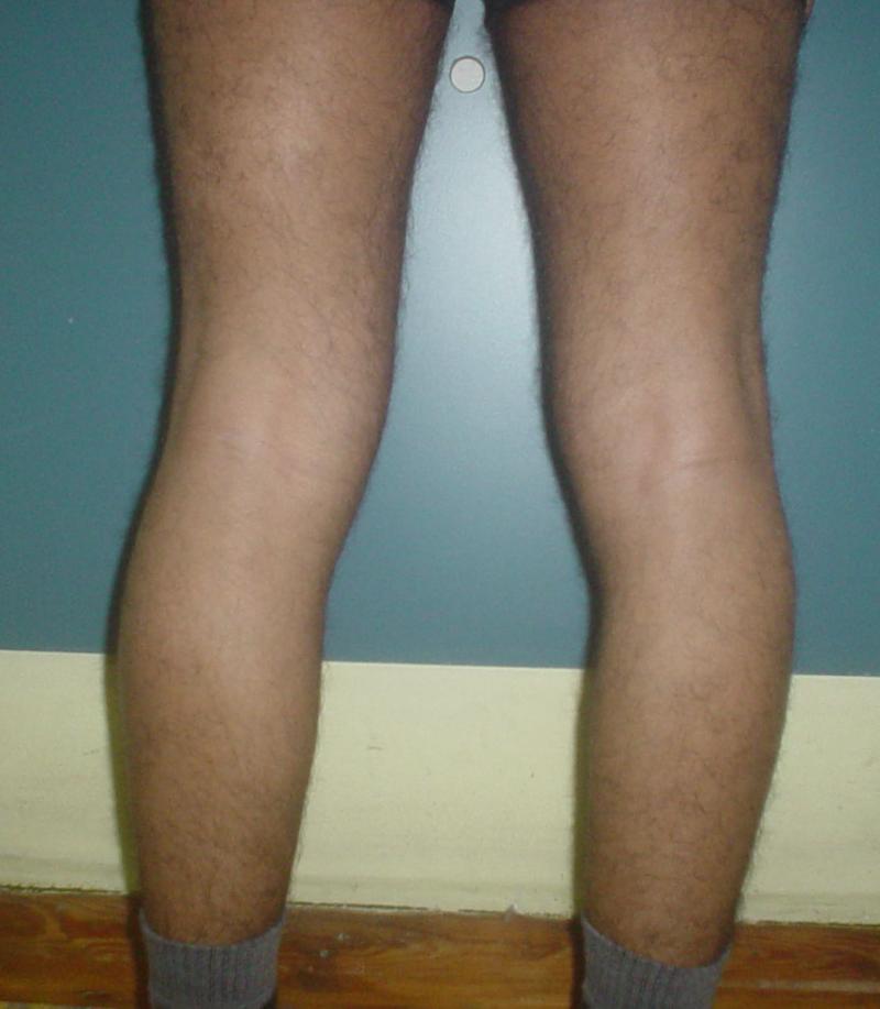 Cosmetic Surgery Egypt,Calf Augmentation,Calf Implants,Fat Injection,Leg cosmeti