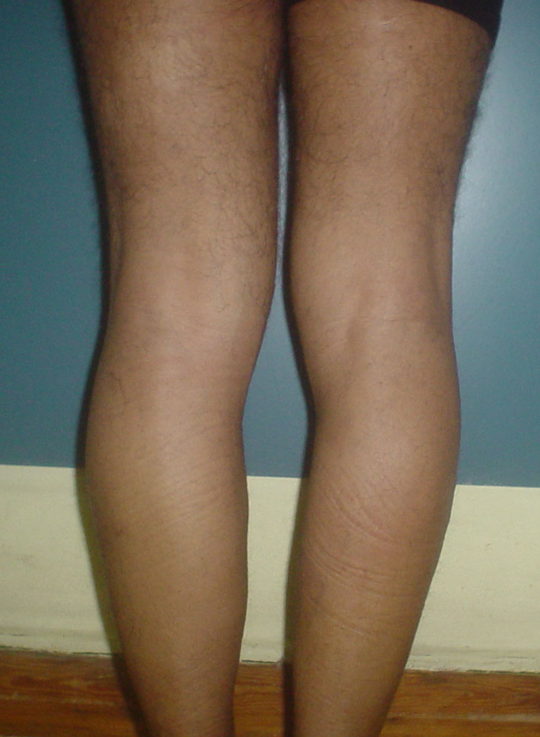 Plastic Surgery Egypt,Calf Augmentation,Calf Implants,Fat Injection,Leg cosmetic