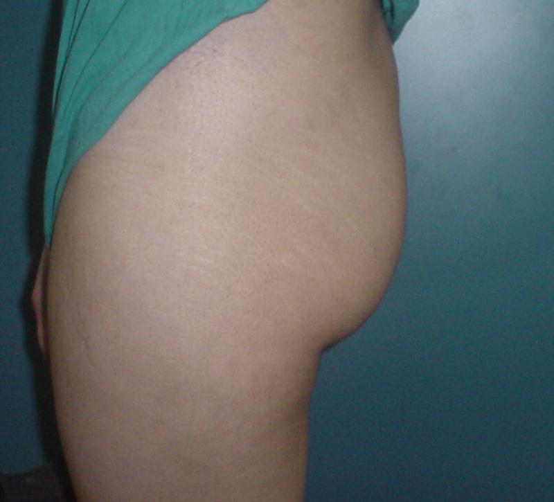Cosmetic Surgery Egypt,Buttock Augmentation,Buttock Implants,Gluteal Enhancement