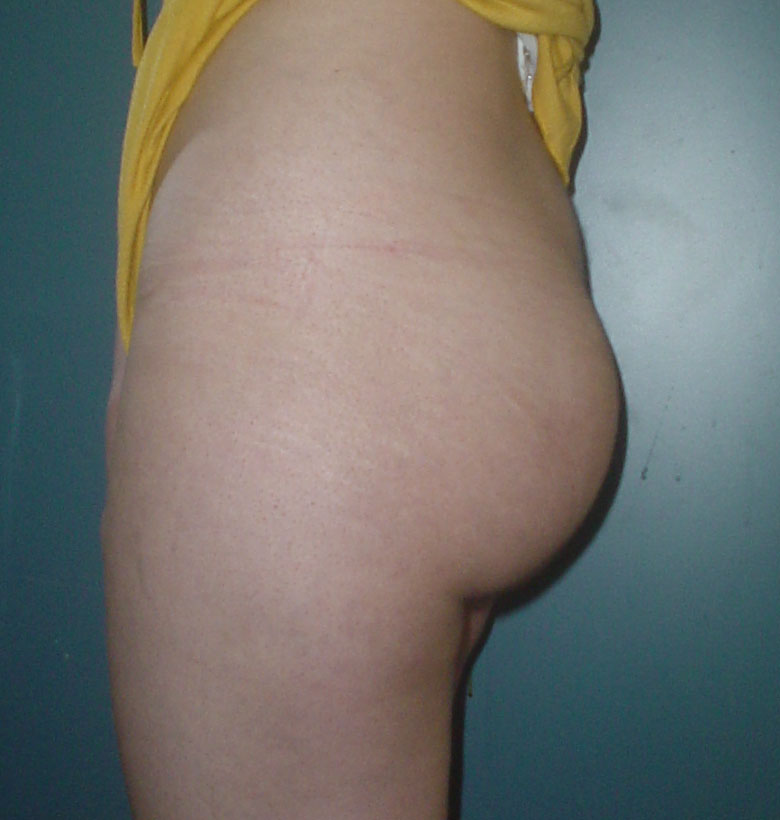 Plastic Surgery Egypt,Buttock Augmentation,Buttock Implants,Gluteal Enhancement
